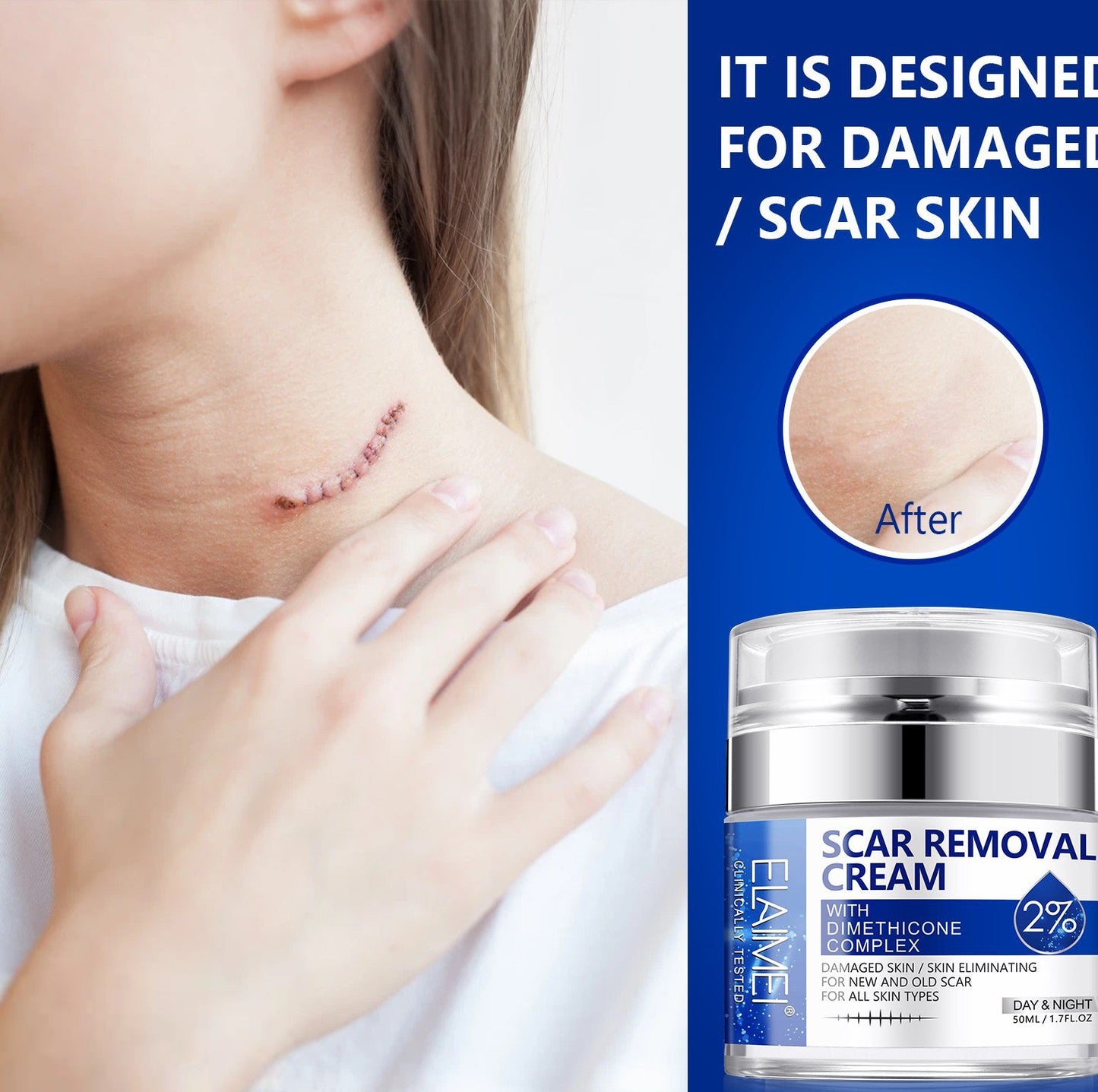 SCAR REMOVAL CREAM