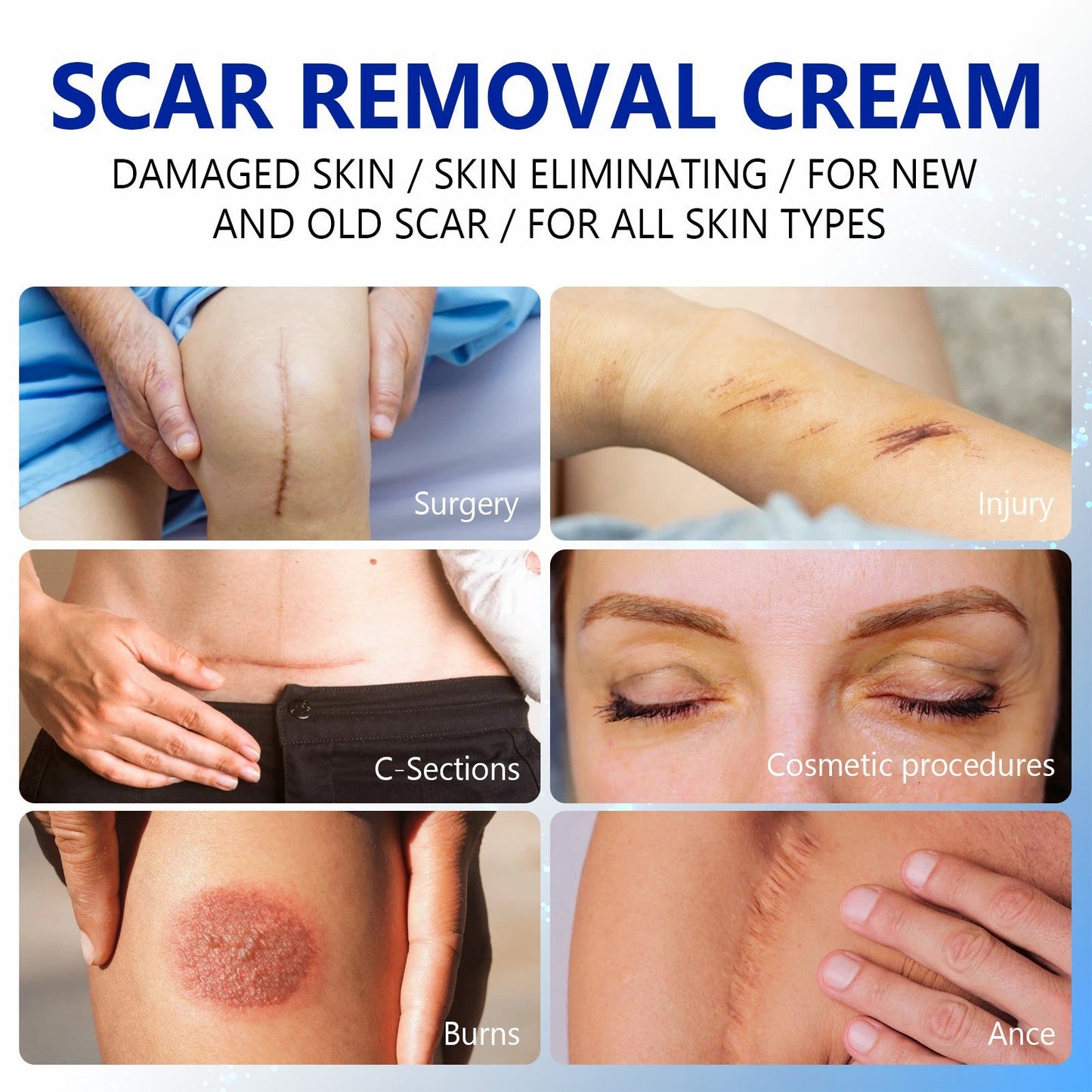 SCAR REMOVAL CREAM